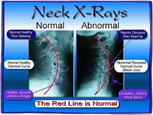 Bad Posture Causes Arthritis?!?!: Advanced Back & Neck Pain Center:  Chiropractic