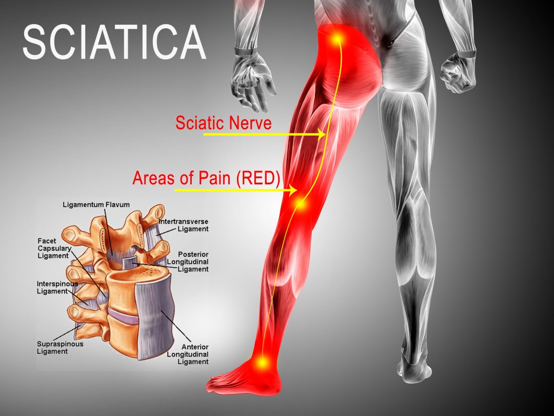 sciatic-nerve-down-leg-diagram